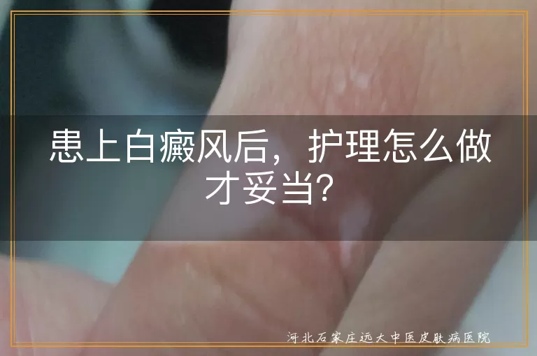 患上白癜风后，护理怎么做才妥当？