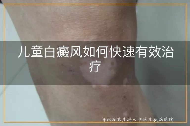 儿童白癜风如何快速有效治疗