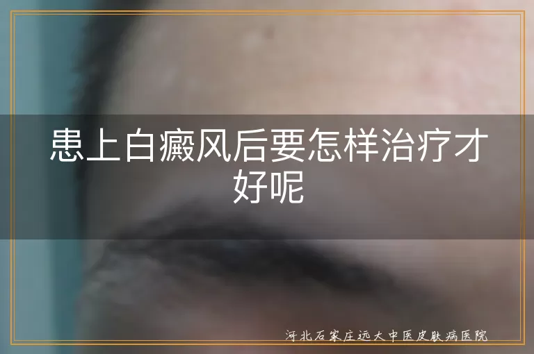 患上白癜风后要怎样治疗才好呢