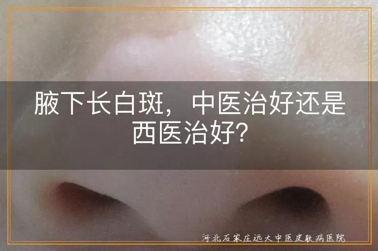 腋下长白斑，中医治好还是西医治好？