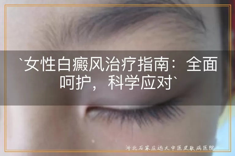 女性白癜风治疗指南：全面呵护，科学应对
