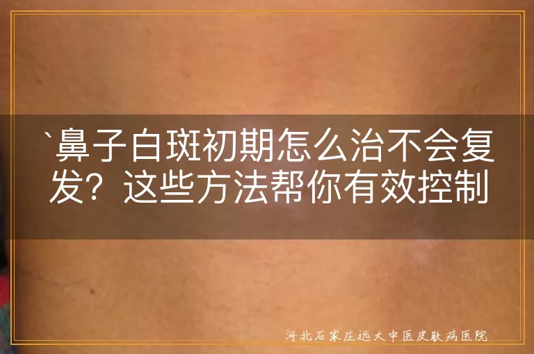 鼻子白斑,初期治疗,预防复发,生活习惯,及时就医