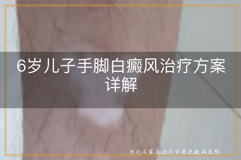6岁儿子手脚白癜风治疗方案详解