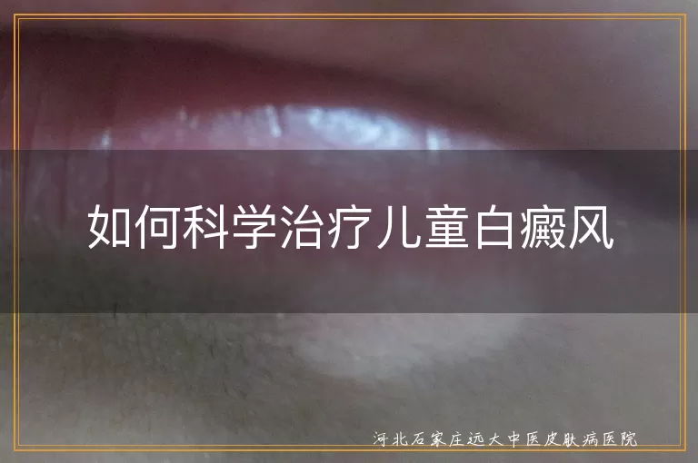 如何科学治疗儿童白癜风