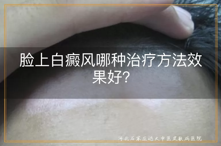 脸上白癜风哪种治疗方法效果好？