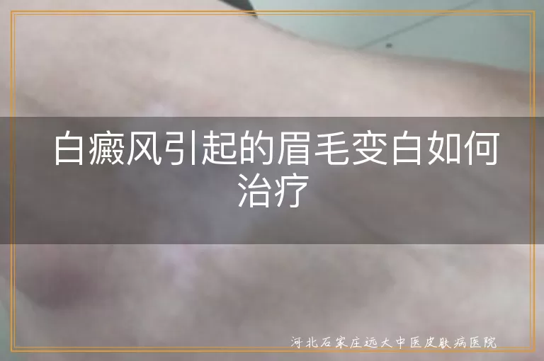 白癜风,眉毛变白,药物治疗,物理治疗,手术治疗,日常护理,心态调整