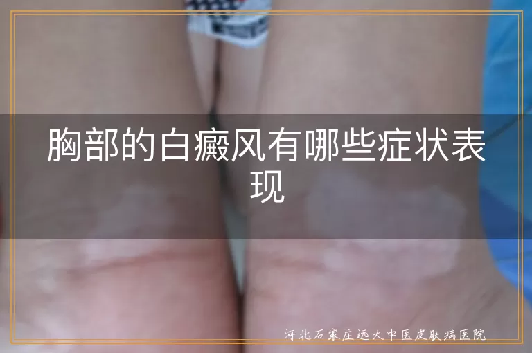 胸部的白癜风有哪些症状表现