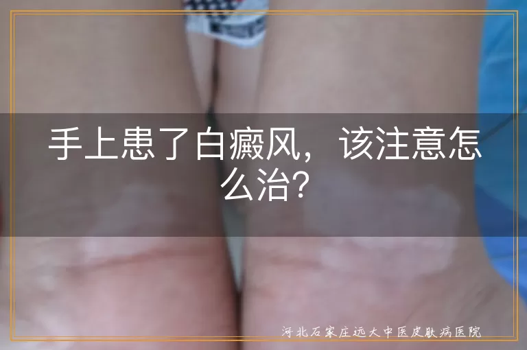 手上患了白癜风，该注意怎么治？