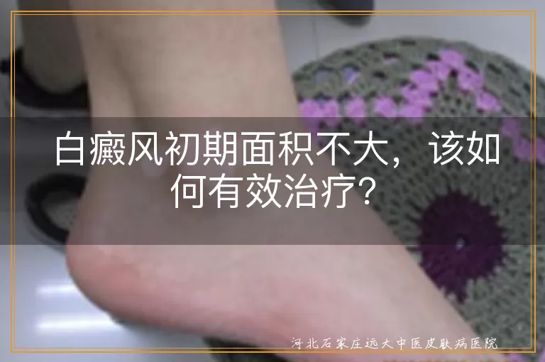 白癜风初期面积不大，该如何有效治疗？