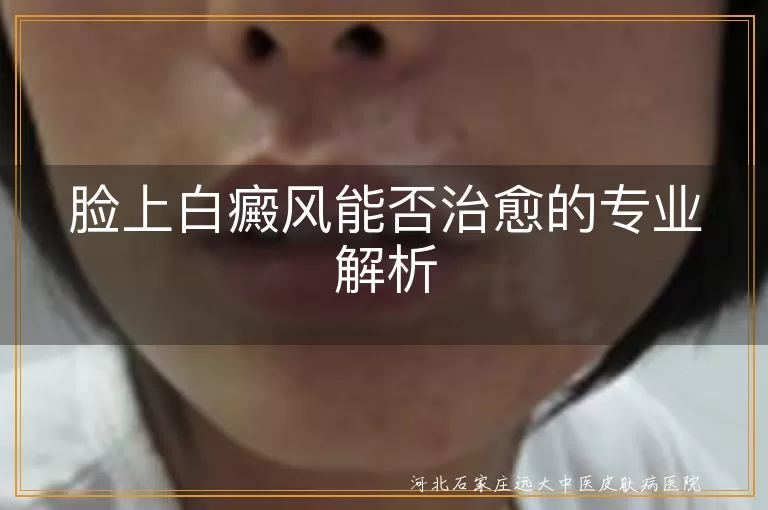 脸上白癜风能否治愈的专业解析