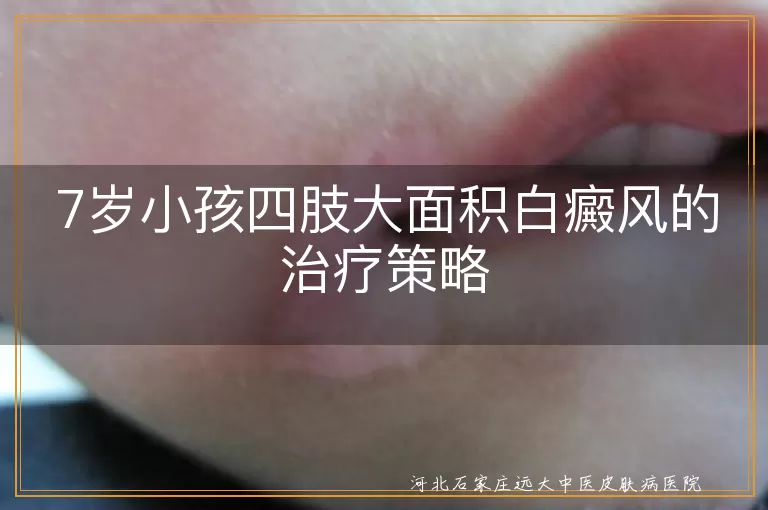 7岁小孩,四肢白癜风,治疗策略,及时就医,综合治疗,生活护理,定期复查