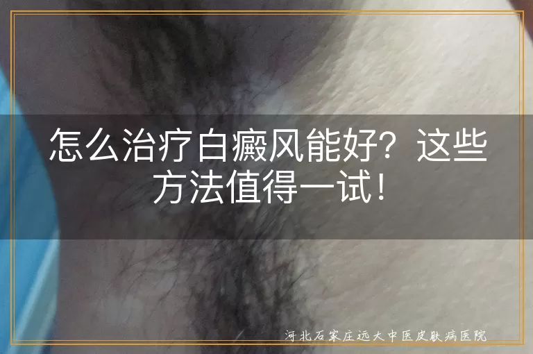 白癜风,治疗方法,药物治疗,光疗,激光治疗,中医治疗,心理治疗,细节,坚持,防晒,饮食调理,心态