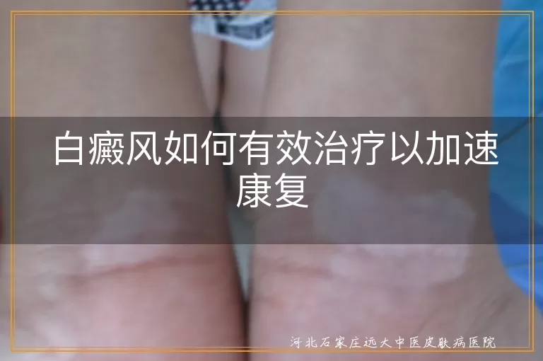 白癜风如何有效治疗以加速康复