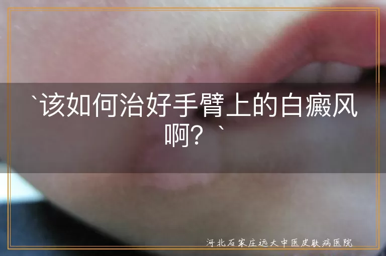 该如何治好手臂上的白癜风啊？