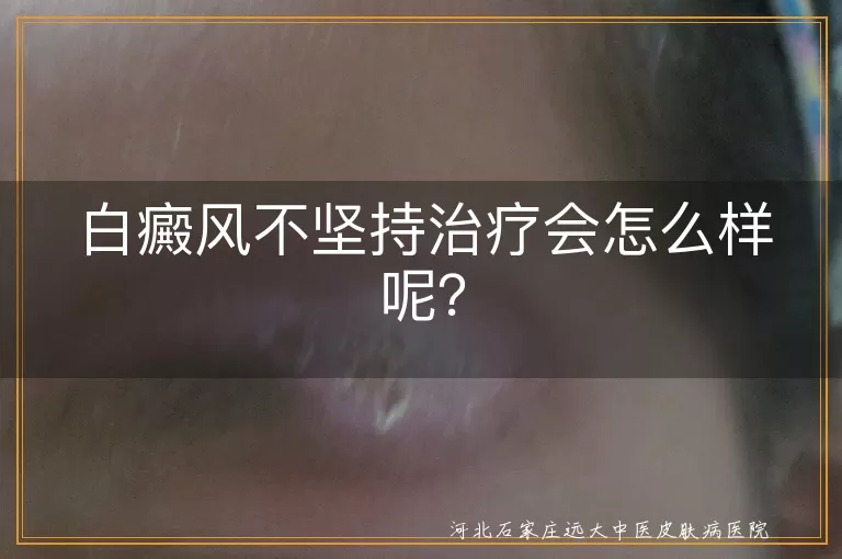 白癜风不坚持治疗会怎么样呢？