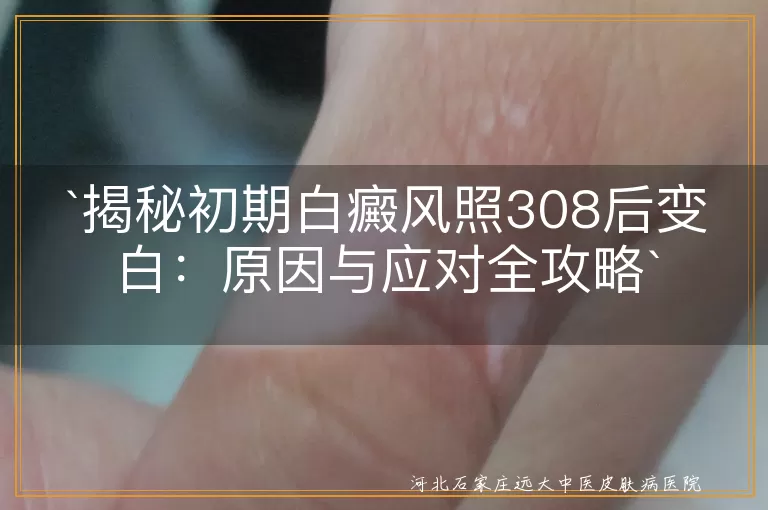 `白癜风,308激光,皮肤变白,治疗反应,皮肤护理,防晒,合理用药`