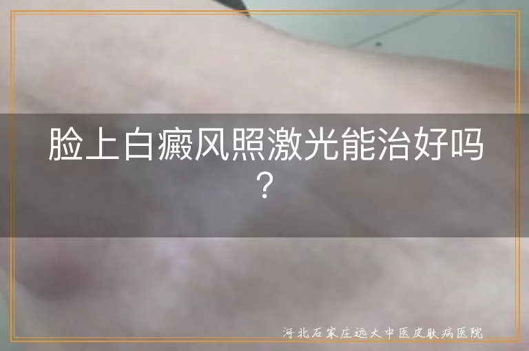 脸上白癜风照激光能治好吗？