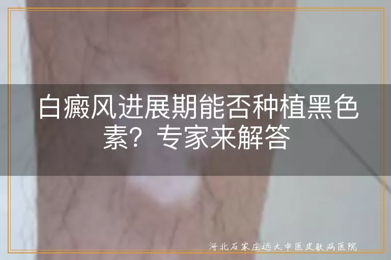 白癜风进展期能否种植黑色素？专家来解答