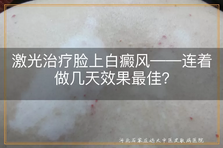 激光治疗脸上白癜风——连着做几天效果最佳？