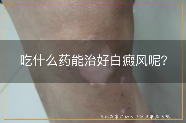 白癜风,药物治疗,糖皮质激素,中成药,维生素D3,光疗,局部外用药,物理疗法,手术,注意事项