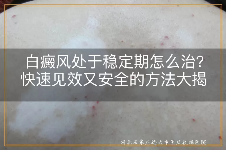 白癜风稳定期,综合治疗,药物治疗,光疗,物理治疗,手术治疗,生活调理,定期复诊