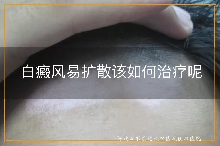 白癜风,扩散,治疗,药物,光疗,手术,日常护理,合理饮食,防晒,心态