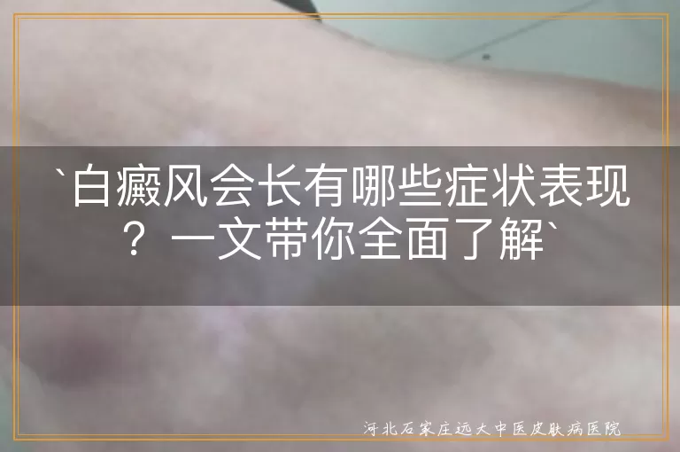 白癜风会长有哪些症状表现？一文带你全面了解
