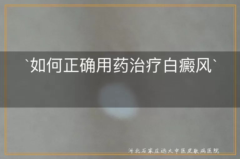 如何正确用药治疗白癜风