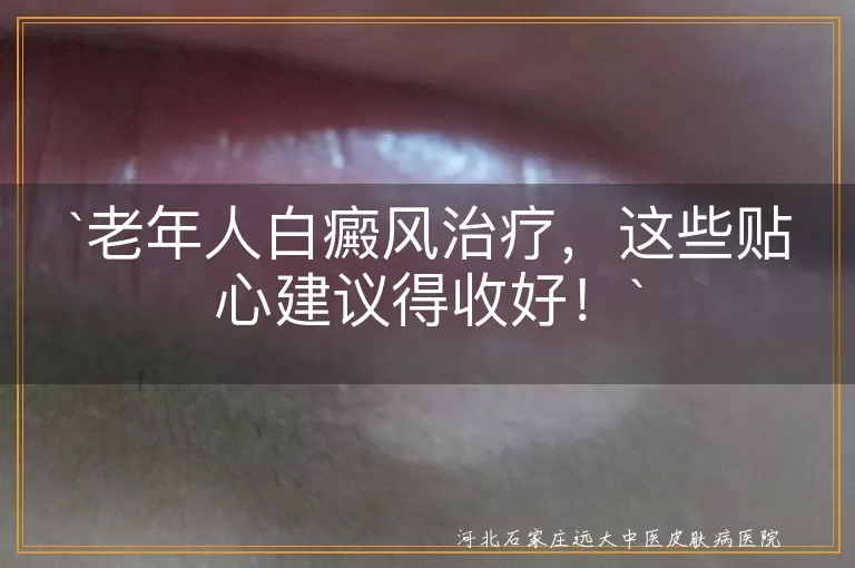 老年人白癜风治疗，这些贴心建议得收好！