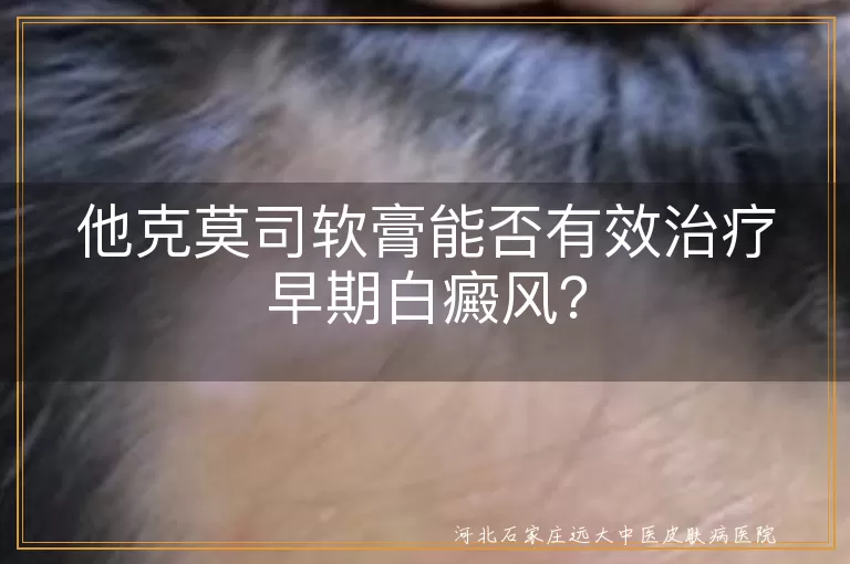 他克莫司软膏能否有效治疗早期白癜风？