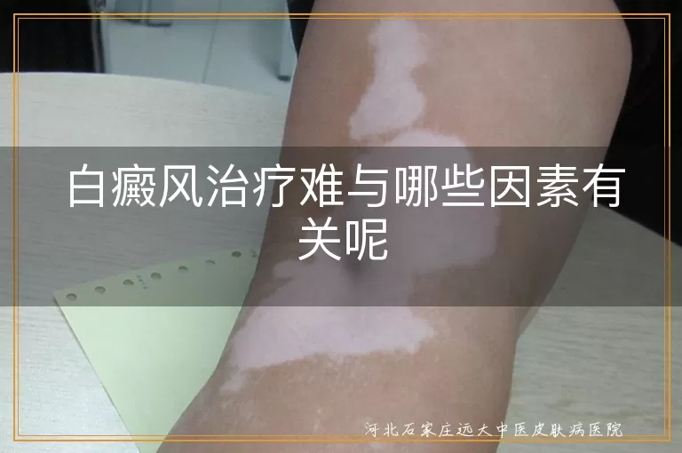 白癜风治疗难与哪些因素有关呢