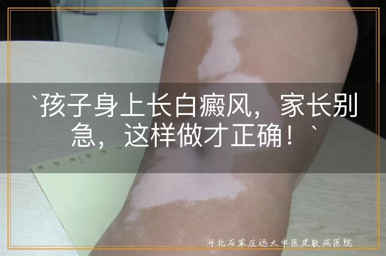 孩子身上长白癜风，家长别急，这样做才正确！