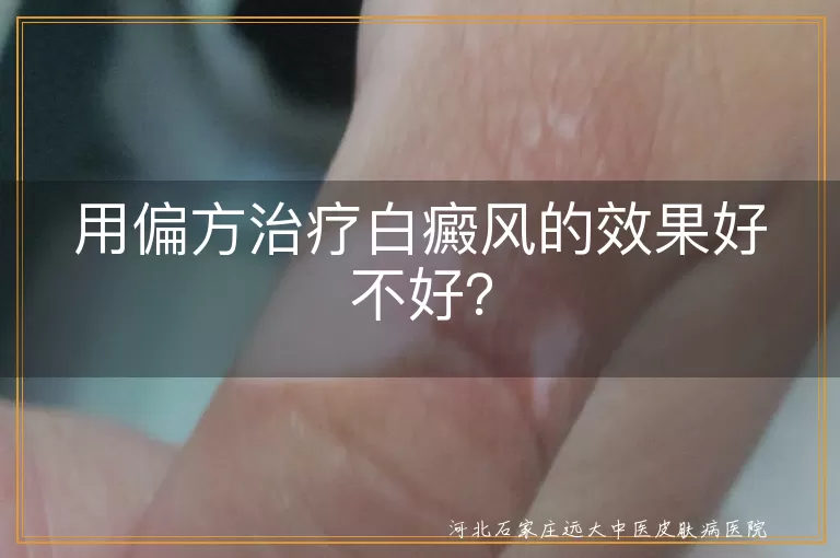 用偏方治疗白癜风的效果好不好？