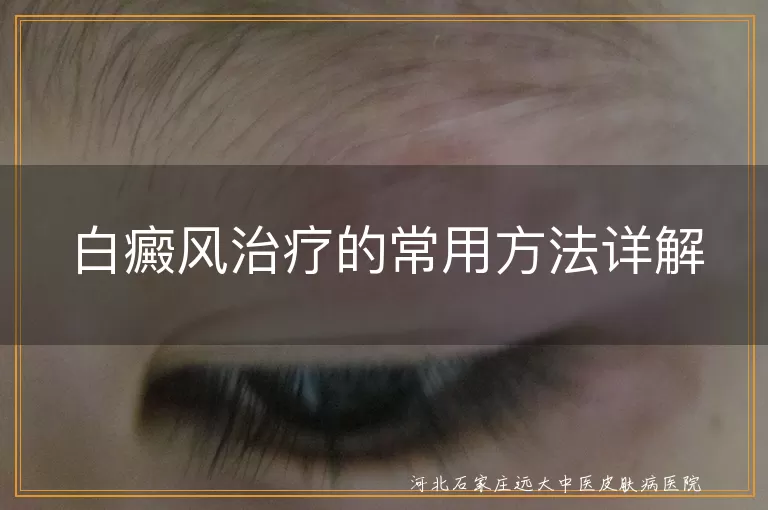 白癜风治疗的常用方法详解