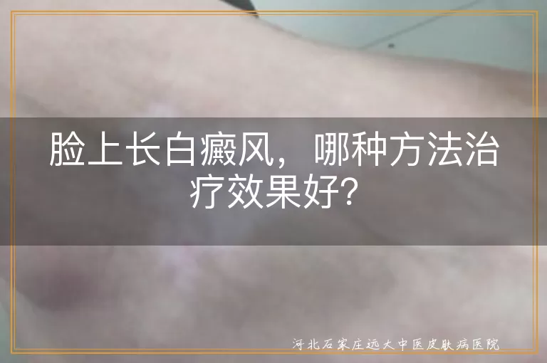 脸上长白癜风，哪种方法治疗效果好？