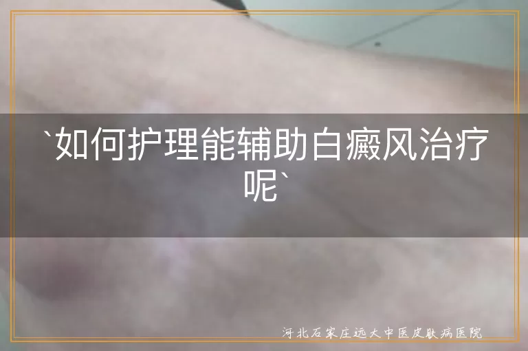 如何护理能辅助白癜风治疗呢