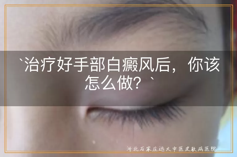 治疗好手部白癜风后，你该怎么做？
