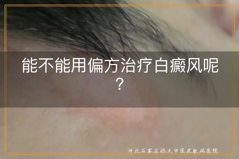 能不能用偏方治疗白癜风呢？