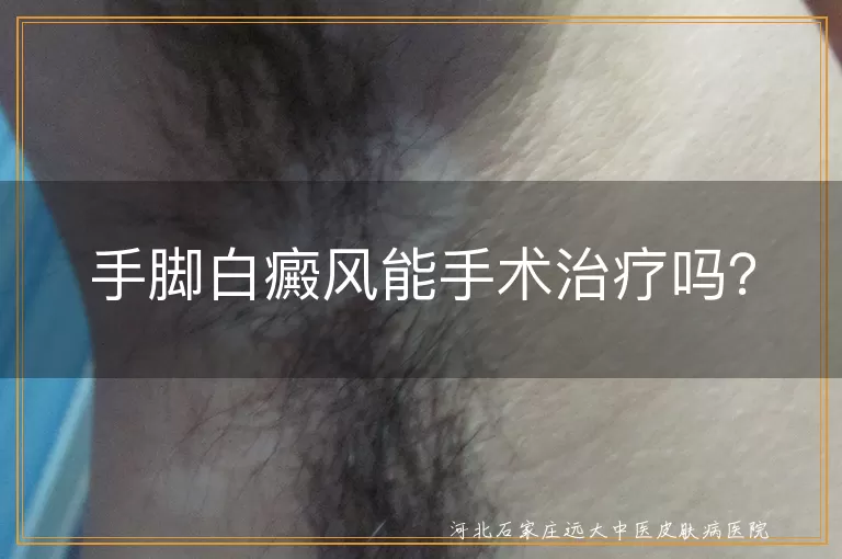 手脚白癜风能手术治疗吗？