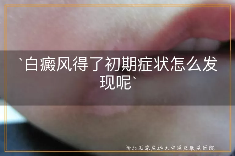 白癜风得了初期症状怎么发现呢