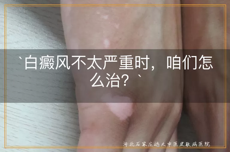 白癜风,轻度,治疗,外用药膏,光照治疗,中药调理,预防复发