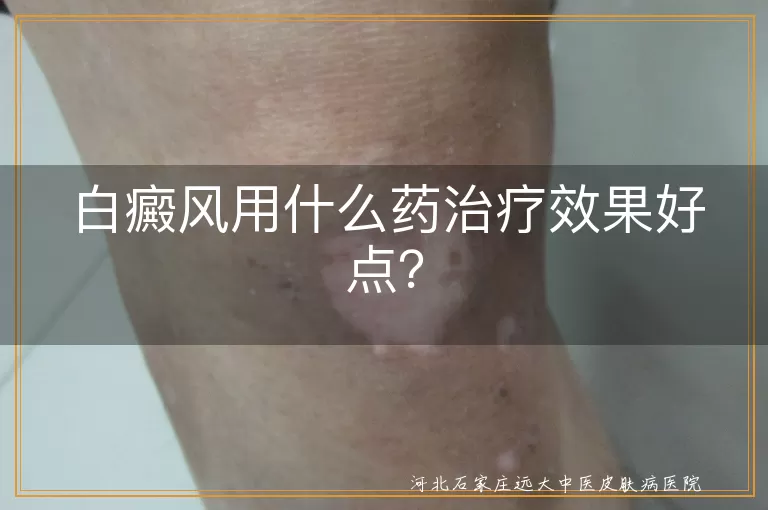 白癜风用什么药治疗效果好点？