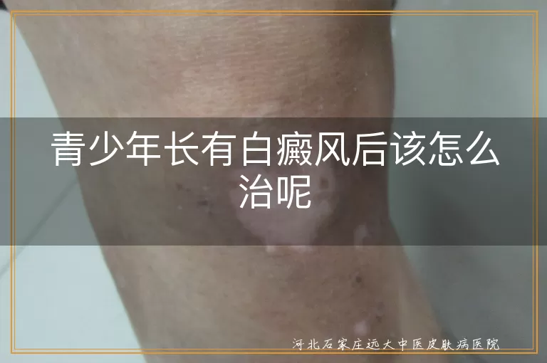 青少年,白癜风,治疗,药物,物理疗法,手术,日常护理,防晒,饮食调整,心理调适