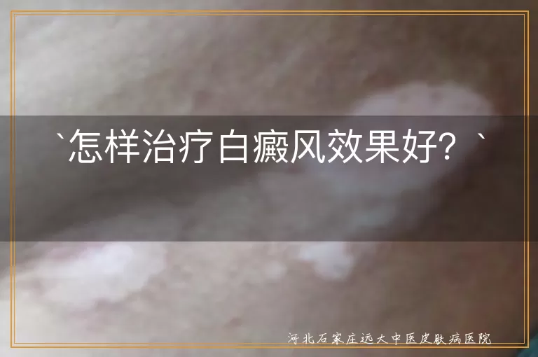 怎样治疗白癜风效果好？