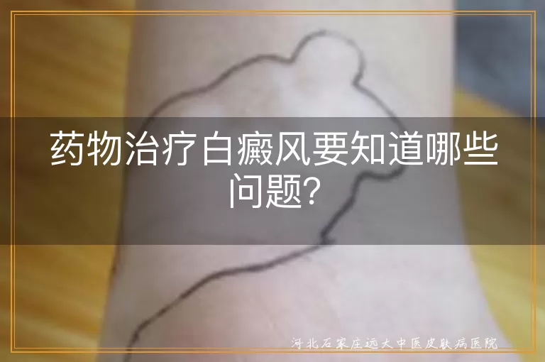 药物治疗白癜风要知道哪些问题？