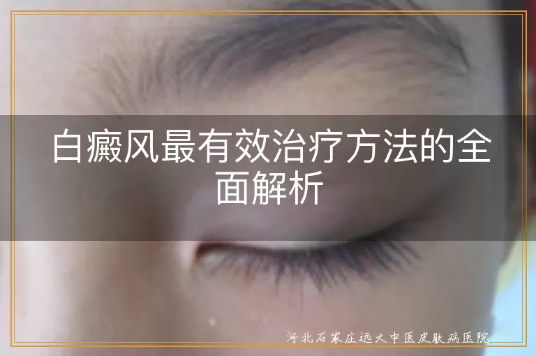 白癜风最有效治疗方法的全面解析