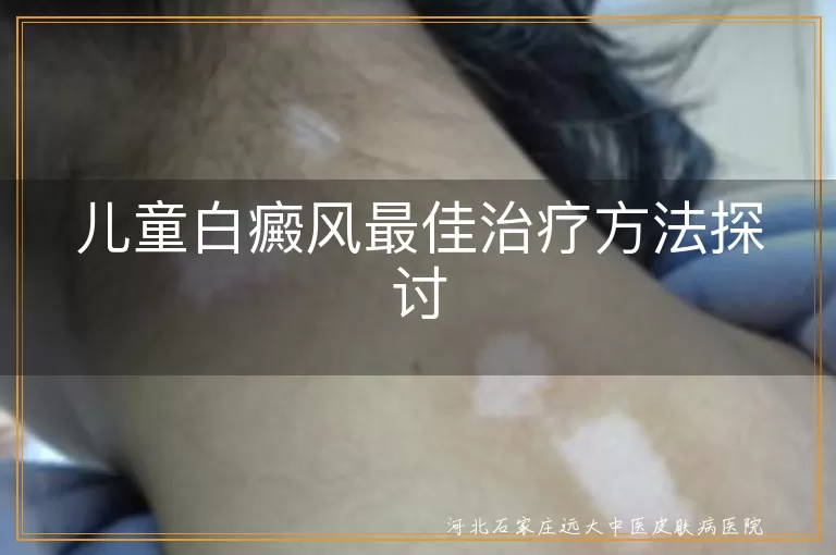儿童白癜风最佳治疗方法探讨