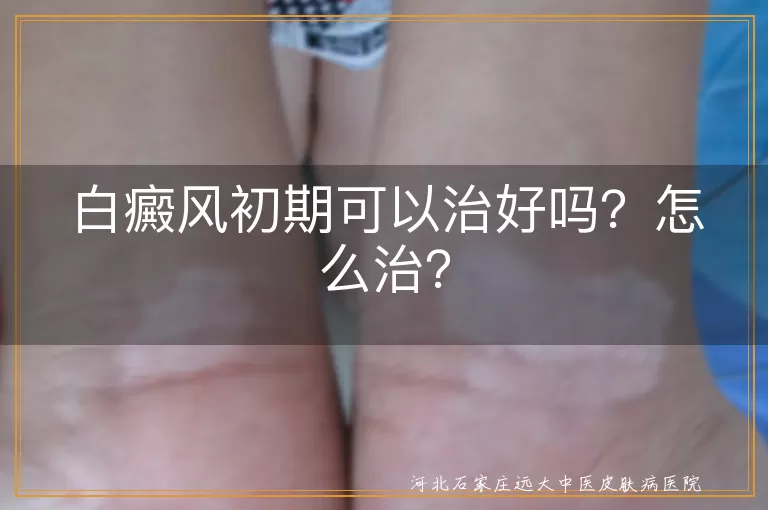白癜风初期,治愈率,药物治疗,物理治疗,手术治疗,饮食调整,皮肤护理,心理治疗