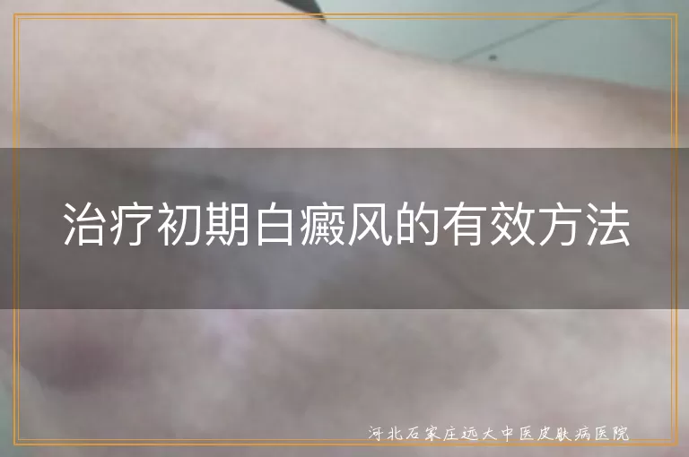 治疗初期白癜风的有效方法