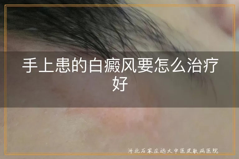 手上患的白癜风要怎么治疗好